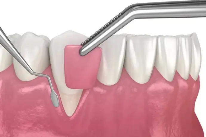 Gum Surgeries