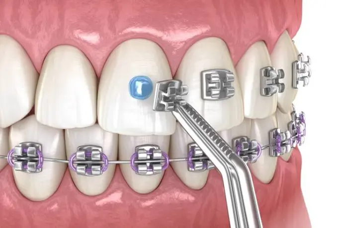 Orthodontic Treatment