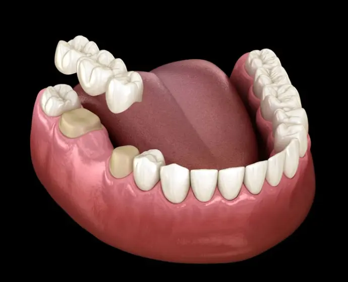 Teeth Alignment