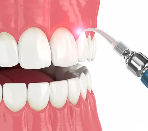 Laser Surgeries