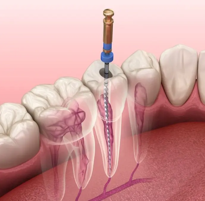 Root Canal Treatment 